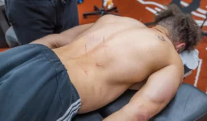 Dry needling treatment on thoracic and lumbar muscles for chronic pain and injury recovery in Naperville.