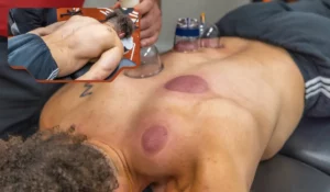 Sports medicine acupuncture and cupping therapy combined for pain relief and mobility restoration in Naperville clinic