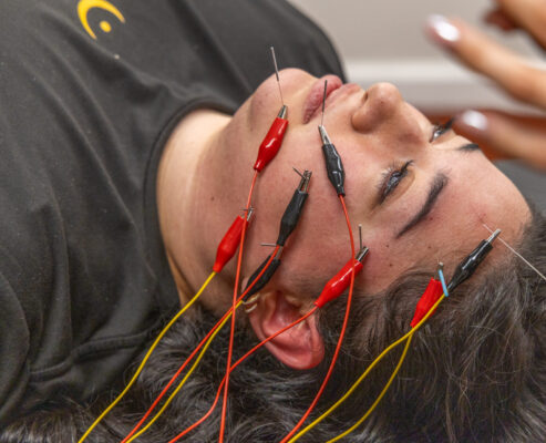 Neurofunctional Acupuncture